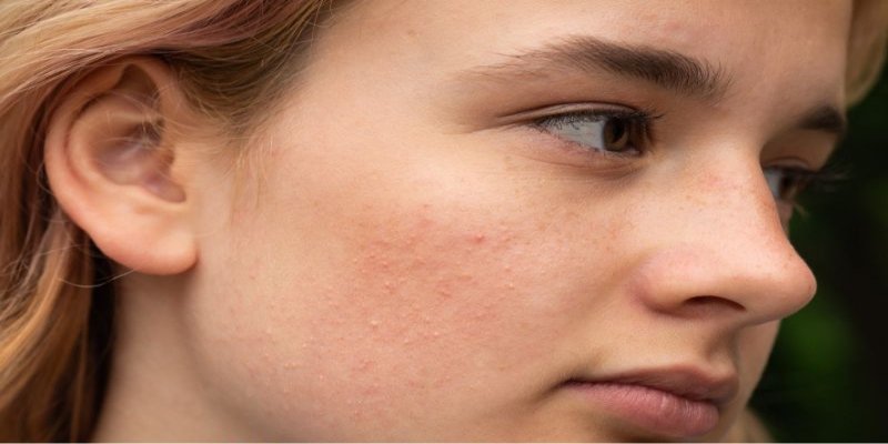 Banish Blemishes: Your Comprehensive Guide to Getting Rid of Acne